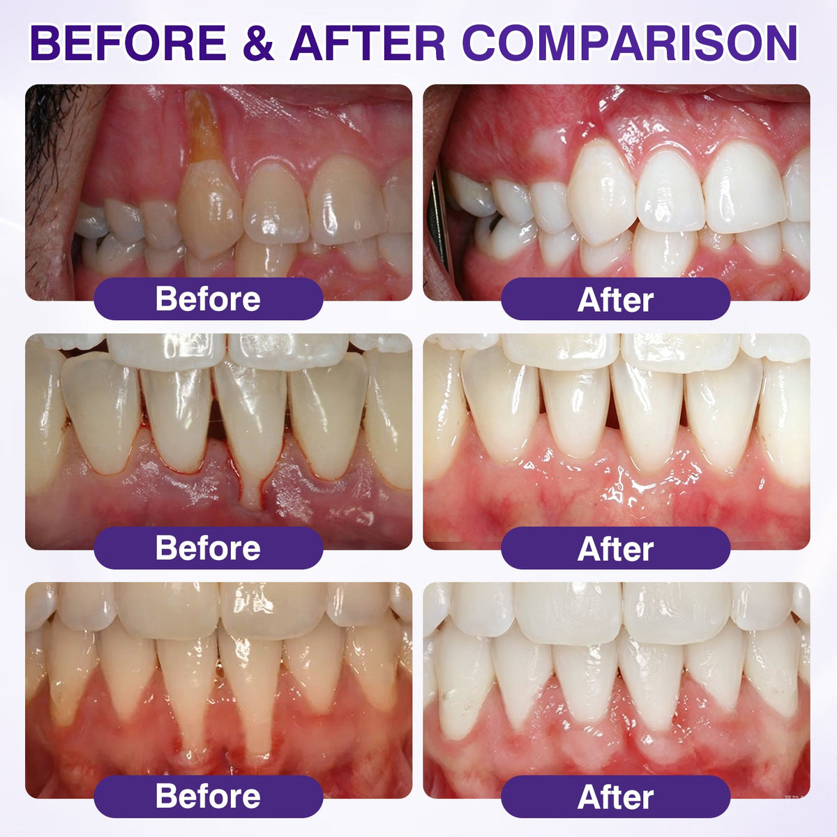 🇨🇦🎁Advanced Formula🦷Evolvion® GumRevive Periodontal Repair Gel