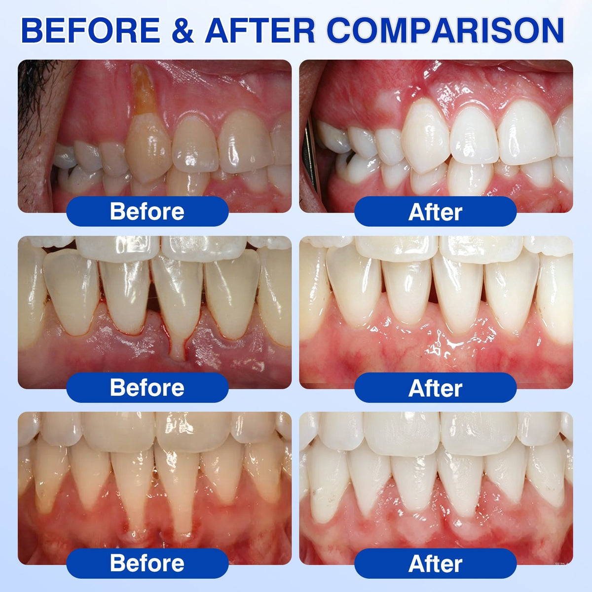 🇨🇦👨‍⚕️✅🦷Evolvion® GumRevive Periodontal Repair Gel